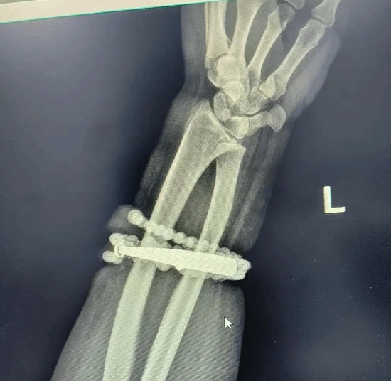 33岁女性戴手镯十年未取下，因体重增加致手镯嵌入皮肉引发严重感染