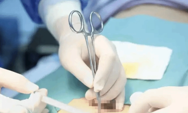 男子通过植入芯片成功戒除二十年酒瘾：从每日豪饮三斤到对酒彻底失去兴趣