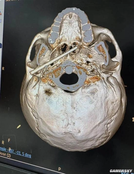 医生成功挽救被筷子插入颅底的患者，该筷子距离大动脉仅5毫米！