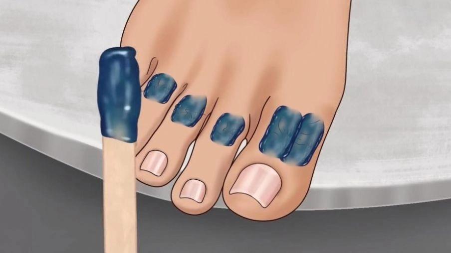 修脚足疔模拟器图2