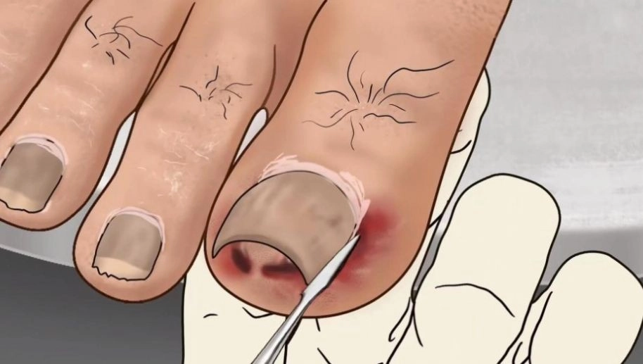 修脚足疔模拟器图3